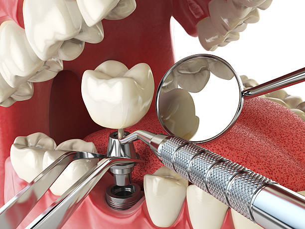 Best Emergency Root Canal Treatment in Marthasville, MO